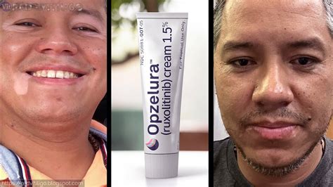 First time posting here. . Opzelura vitiligo reviews